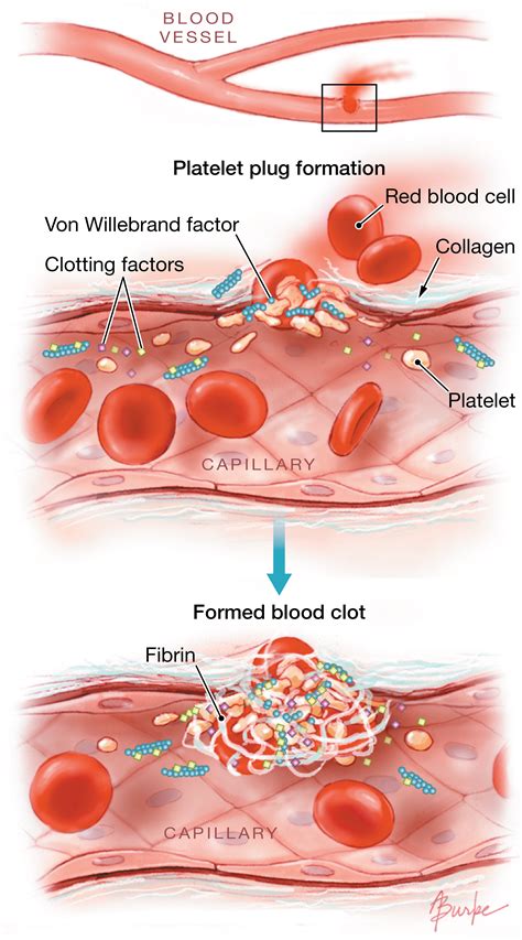 Overview of Bleeding Caused by Abnormal Blood Vessels.